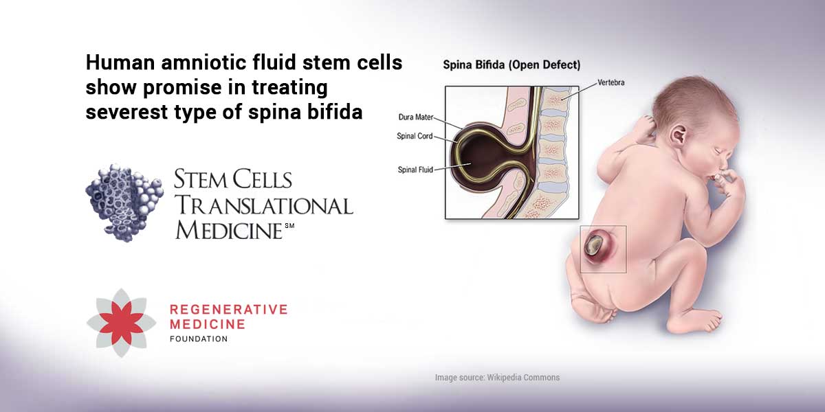Human amniotic fluid stem cells show promise in treating severest type of spinal bifida