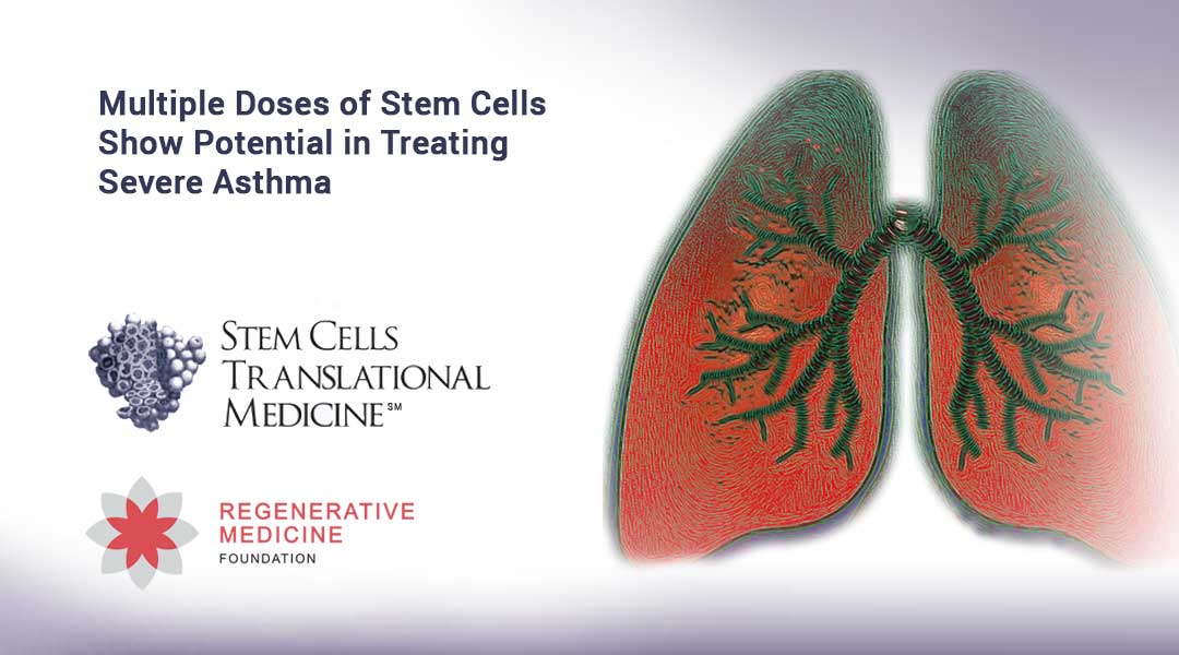 Multiple Doses of Stem Cells Show Potential in Treating Severe Asthma