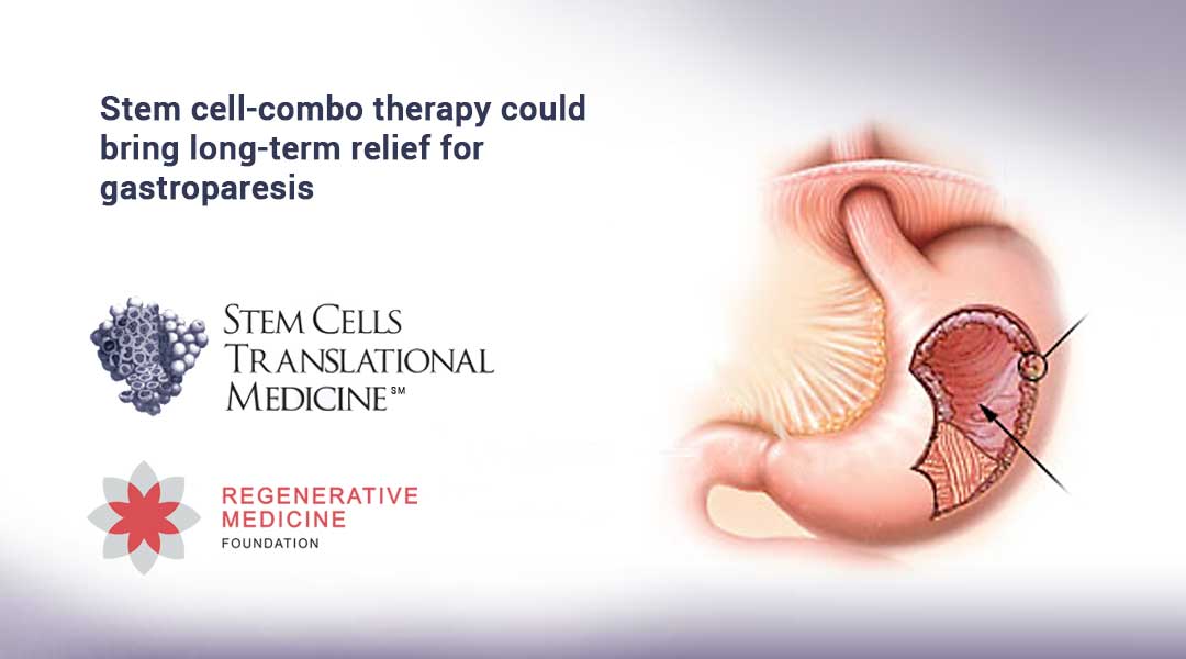 Stem cell-combo therapy could bring long-term relief for gastroparesis