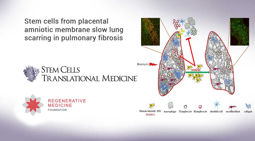 Stem cells from placental amniotic membrane slow lung scarring in pulmonary fibrosis